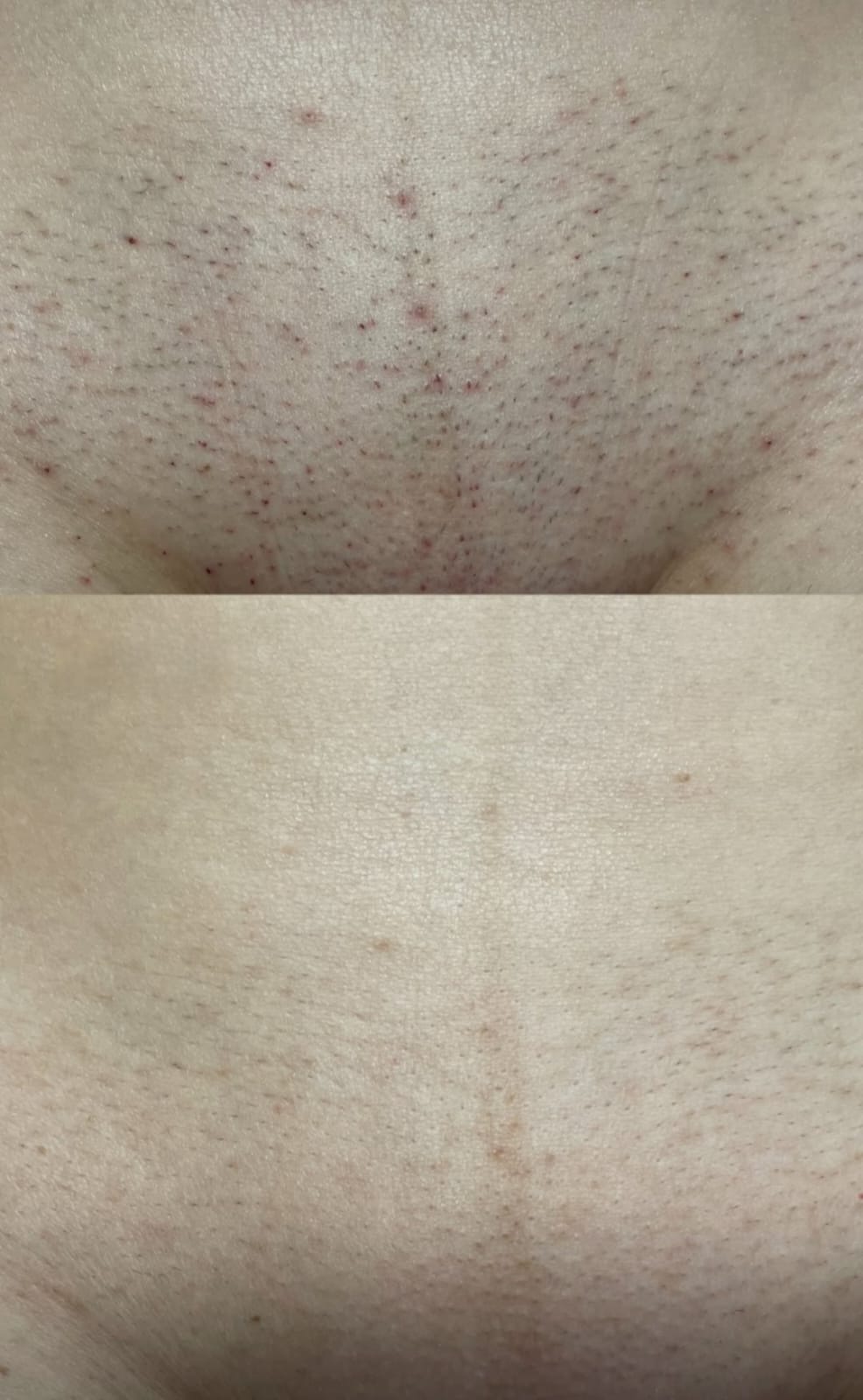 Voor en na resultaat laserontharing 1