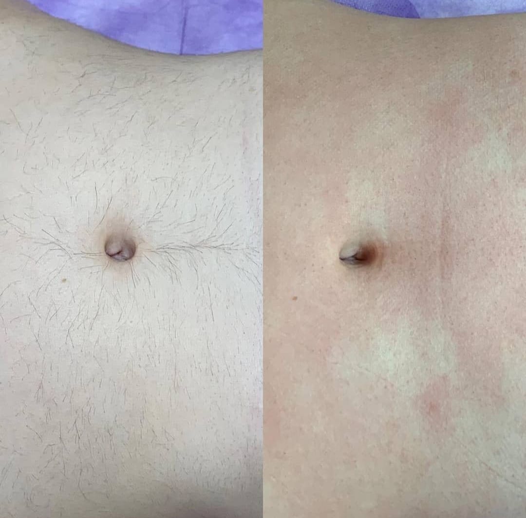 Voor en na resultaat laserontharing 2